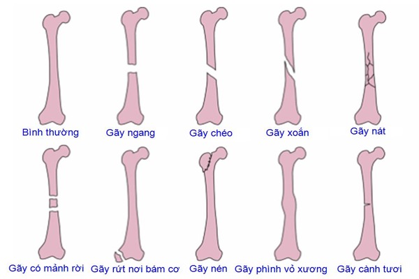 Các giai đoạn phục hồi theo vị trí gãy xương