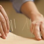 Tổng quan về phương pháp châm cứu phục hồi chấn thương thể thao