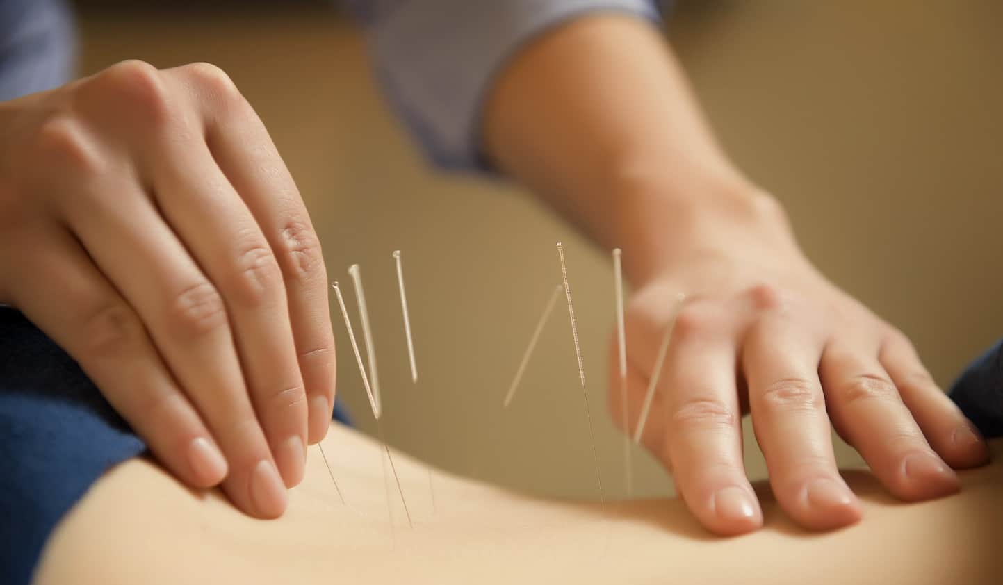 Tổng quan về phương pháp châm cứu phục hồi chấn thương thể thao