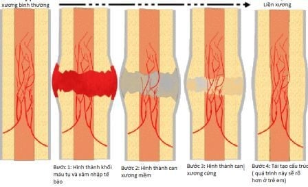 Tổng quan về quá trình phục hồi sau gãy xương và các phương pháp điều trị