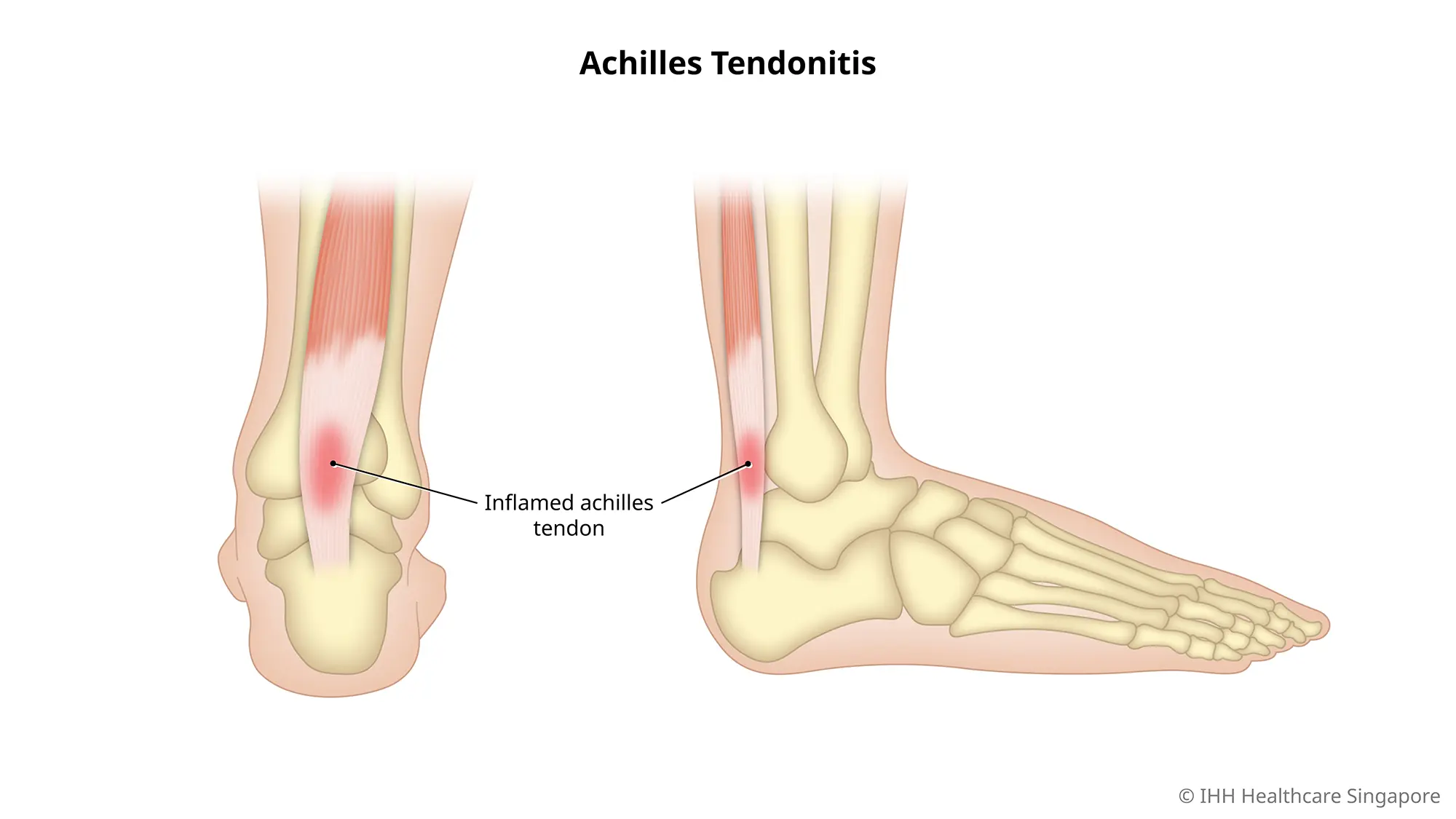 Nguyên nhân và các yếu tố làm tăng nguy cơ viêm gân Achilles