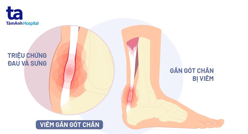 Phương pháp điều trị viêm gân Achilles hiệu quả