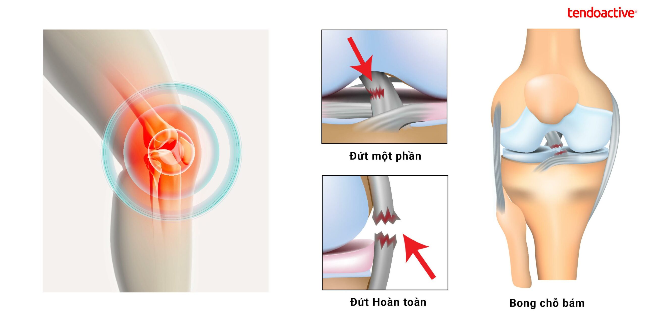 Thời gian và các mốc phục hồi quan trọng sau phẫu thuật dây chằng