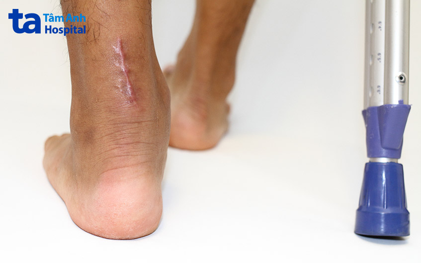 Thời gian và cách phục hồi sau điều trị viêm gân Achilles