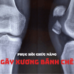 tong-quan-ve-qua-trinh-phuc-hoi-sau-gay-xuong-va-cac-phuong-phap-dieu-tri