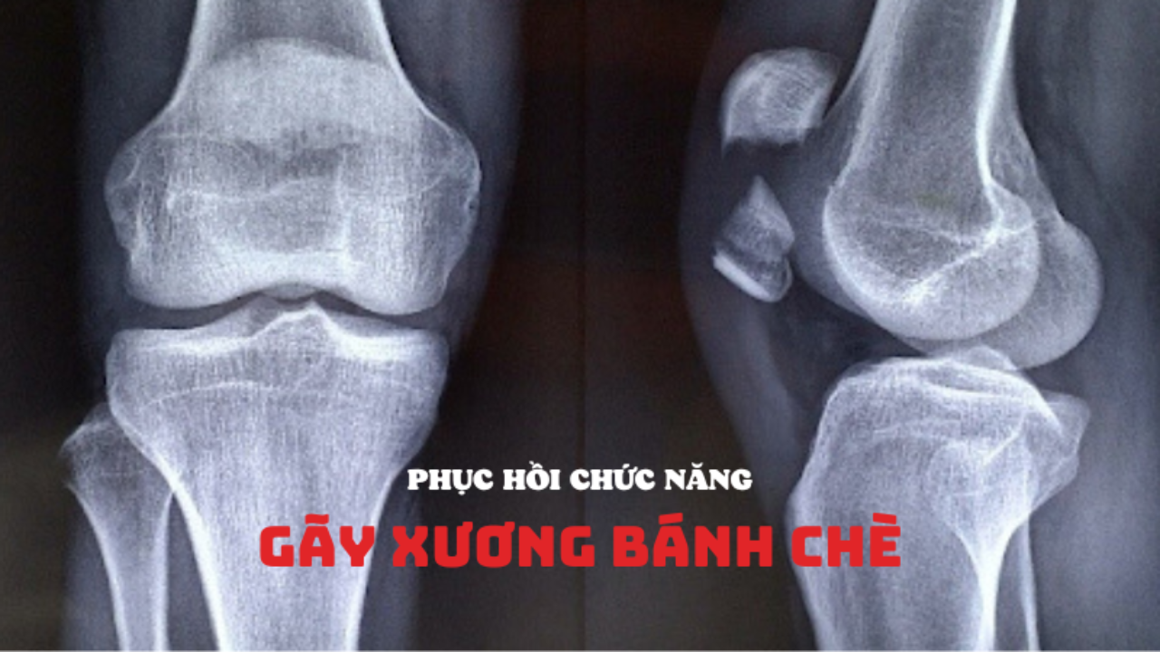 tong-quan-ve-qua-trinh-phuc-hoi-sau-gay-xuong-va-cac-phuong-phap-dieu-tri